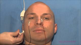 Motoric Neurography  Facial Nerve [upl. by Airamana]