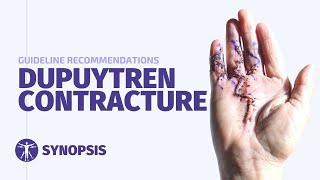 Dupuytrens Contracture Guideline  SYNOPSIS [upl. by Newol600]