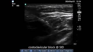 Costoclavicular block  13 sept 24 [upl. by Sivie]