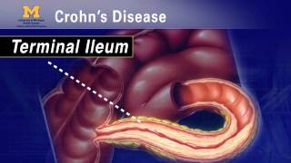 IBD School 102  What is Crohns Disease [upl. by Egbert836]