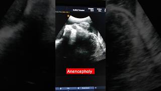 Anencephaly with brain dangling behind in the amniotic fluid anomalyscan [upl. by Sevy152]