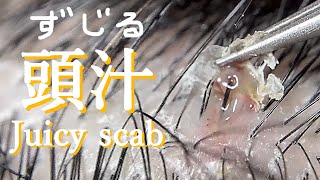 No164「頭汁」浸出液の溜り池  Exudate juicy scab  exudado costra jugosa  滲出多汁痂  육즙이 많은 딱지가 삼출됩니다 [upl. by Truelove]