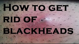 get rid of blackheads [upl. by Massiw315]