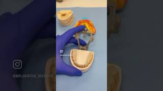 Amelogenesis imperfecta dentist viralreels teeth bestdentist viralvideo viral implant [upl. by Ahsemad]