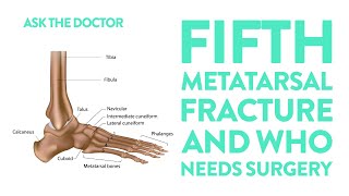 Ask the Doctor Fifth metatarsal fracture and who needs surgery [upl. by Ihcehcu372]