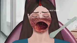 ASMR Animation treatment from infected mouth  2D Animation restasmr1 [upl. by Draillih]