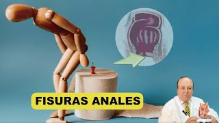 Las Fisuras Anales  Todo lo que querías saber [upl. by Toille]