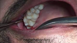 Forceps extraction of decayedbuccoverted upper 3rd molar [upl. by Nitreb861]