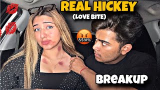 Real Hickey Love Bite 💋 Prank On Anmol  He Got Extremely Angry 🤬 [upl. by Elamaj]