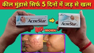 acnestar gel review एक्ने पिंपल्स जड़ से खत्म करने की दवा acnestar gel kaise use kare  acnestar [upl. by Ariaic]