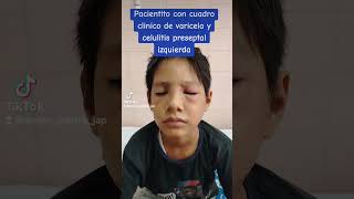 Caso de Varicela con Celulitis mastermedinatropicalysalud9670 [upl. by Bell]