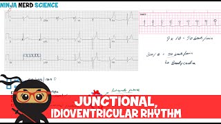 Rate and Rhythm  Junctional and Idioventricular Rhythm [upl. by Silsbye127]