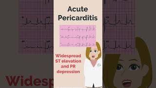 Acute Pericarditis and Myocardial Infarction  PLAB  UKMLA  MedRevisions [upl. by Eslud324]