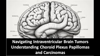 Navigating Intraventricular Brain Tumors Understanding Choroid Plexus Papillomas and Carcinomas [upl. by Joscelin620]