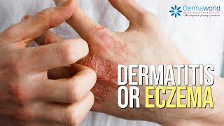 Dermatitis or Eczema  Causes Symptoms and Treatment  Dr Rohit Batra Explains [upl. by Ennire]