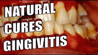 How to Get Rid of GINGIVITIS at Home NATURALLY amp EASILY Gum Disease [upl. by Adhern]