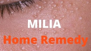 Milia treatment [upl. by Kinghorn]