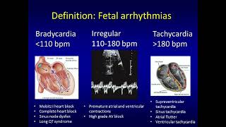 Fetal Arrhythmias and Management by David W Brown MD FAAP [upl. by Chastain]