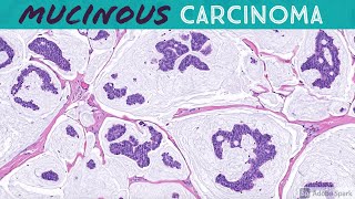 Primary Cutaneous Mucinous Carcinoma amp Endocrine MucinProducing Sweat Gland Carcinoma [upl. by Akessej]