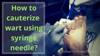 How to remove planter wart using syringe needle [upl. by Chelsey]