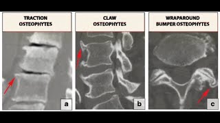 Osteophytes Bone Spurs  Definition causes Symptoms Diagnosis Treatment [upl. by Nerty]