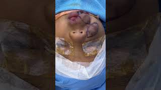 Hemangioma for a kid  best resection and Reconstructive surgery [upl. by Alliber164]