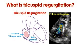 What is Tricuspid Regurgitation TR [upl. by Oek]