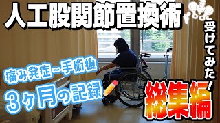 人工股関節置換術受けてみた（総集編）人工股関節置換術股関節手術入院 [upl. by Ardnaik]