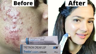 Acne Treatment At Home  TretinoinRetino A 0025cream [upl. by Seften]