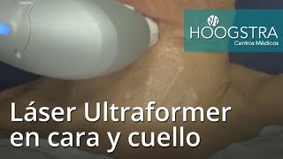 Láser Ultraformer en cara y cuello 17104 [upl. by Pals4]