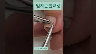 이번엔 발톱이 아니고 손톱 손톱도 관리 할 수 있어요😊 내성손톱 손톱관리 ingrowntoenail 조원장의풋솔루션 [upl. by Bodnar]