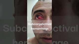 Subconjunctival hemorrhage ophthalmology hemorrhage health [upl. by Meggy]