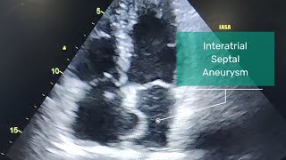 Atrial septal aneurysm l Echo of atrial septal aneurysm [upl. by Solberg972]