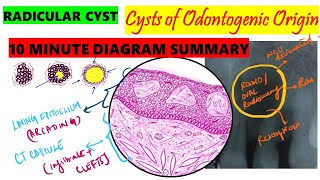 Radicular Cyst 10 MINUTE SUMMARY HISTOPATHOLOGY  Clinical features  Etiopathogenesis  Oral path [upl. by Ondrej]