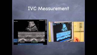 Tutorial Aorta amp IVC [upl. by Prader]