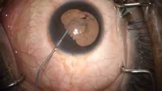 Viscodissection for Central Posterior Synechiae at the Time of Cataract Surgery [upl. by Ydnim]