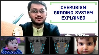 Cherubism Grading System  Dr Bhaumik Joshi  ASPIRE MDS  NEET  AIIMS [upl. by Suivat618]