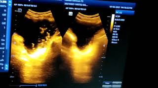 Echoes in urinary bladder diagnosis [upl. by Atnwahs]