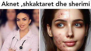 AKNET  Si sherohen aknet  Maska per fytyre maska fytyre acne blackheads lekura acnetreatment [upl. by Arabelle]