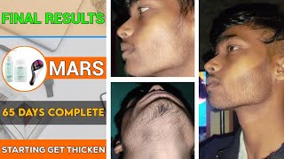 BEARD GROWTH  65 days complete  Starting get more thicken  2 months ✔️ from minoxidil [upl. by Iphigenia]