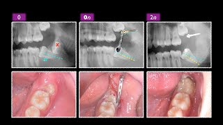 Lower Impacted Molar with Ramus Screw amp aligner｜【Chris Chang Ortho】CC759 [upl. by Schaefer242]