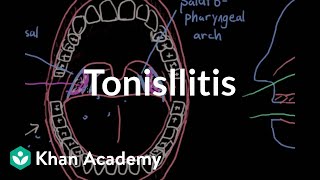 Tonsillitis  Respiratory system diseases  NCLEXRN  Khan Academy [upl. by Enileqcaj905]