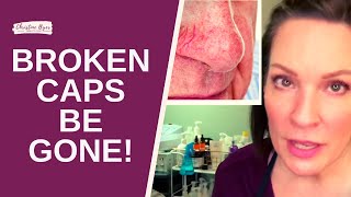 HOW TO REALLY REMOVE BROKEN CAPILLARIES [upl. by Stannwood]