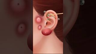 ASMR PIERCING CLEANING amp PIMPLE AND BLACKHEAD REMOVING  EAR INFECTION TREATMENT ANIMATION 👂🤢 [upl. by Nayrda]