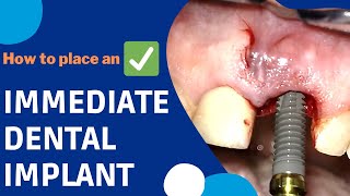 How is an IMMEDIATE DENTAL IMPLANT surgery done implants [upl. by Aplihs]