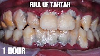 SCALING  SATISFYING  TARTAR  Dentist  Dokter Gigi Tri Putra [upl. by Haonam688]