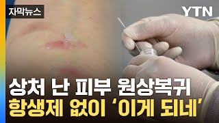 자막뉴스 항생제 안 썼는데도놀라운 상처 치료 기술 탄생  YTN [upl. by Nnayr]