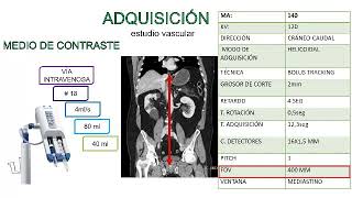 Angiotomografía en el estudio del Aneurisma Aórto Abdominal AAA [upl. by Eelarak858]