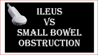 Ultrasound of ileus VS small bowel obstruction [upl. by Gonsalve]