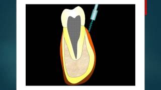 How to put a Miniscrew Lower ArchOrthodontics [upl. by Drannek215]